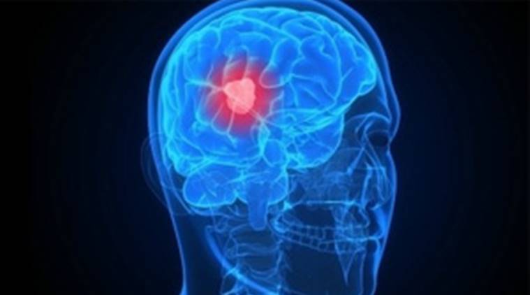 World Brain Tumour Day 2019: Know the symptoms, risk factors and treatment World Brain Tumour Day 2019: Know the symptoms, risk factors and treatment